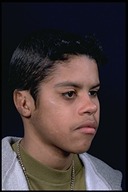 Microtia-After3
