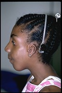 Microtia-After6