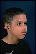 Microtia-Before3