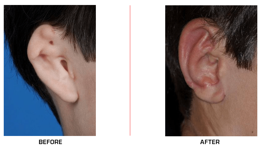 Ear Reconstruction before after case10