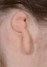lobular microtia