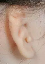 lobular microtia