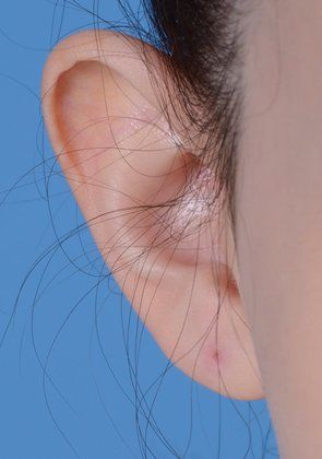 upper ear reduction before